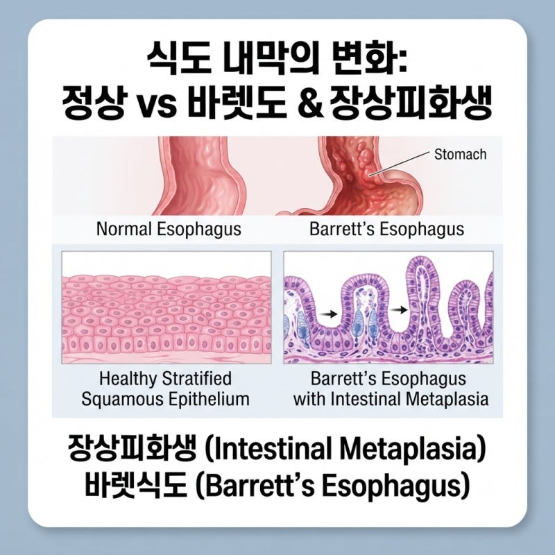 역류성식도염 바렛식도 총정리 ④ 바렛식도란? 암이 되는 걸까? 장상피화생·조직검사·치료....