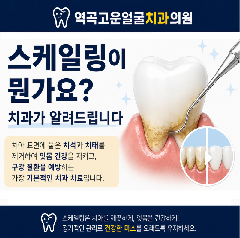 역곡치과 스케일링이란? 치석 제거부터 건강보험까지 총정리