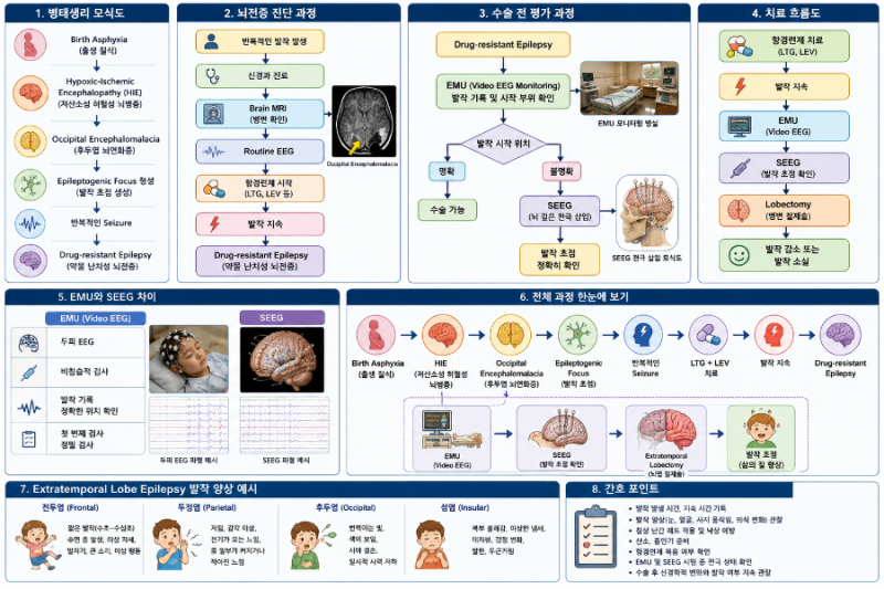 [간호지식]소아뇌전증 치료 항경련제, EMU, SEEG, Lobectomy