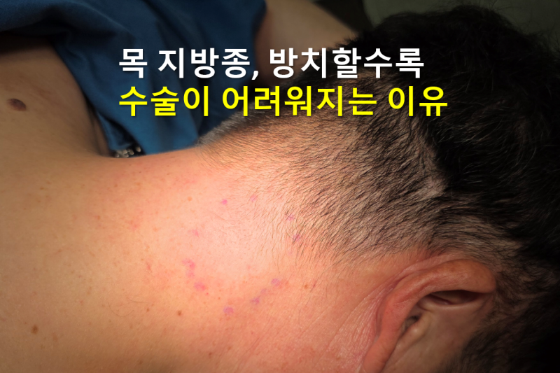 목 지방종 방치하는 것보다 정확한 검진이 중요합니다