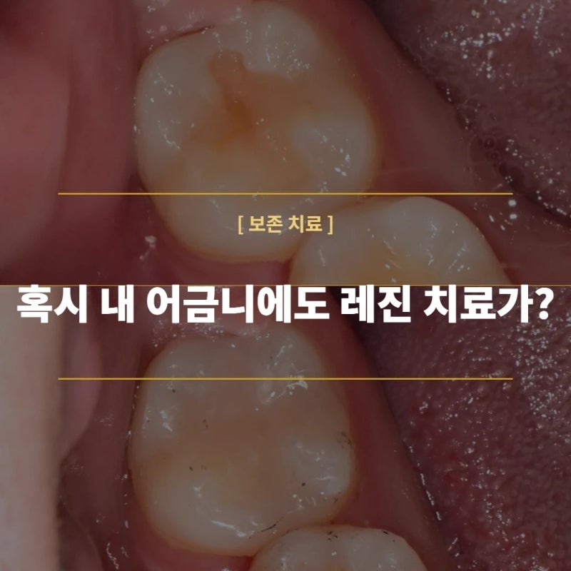 어금니 레진 탈락, 어금니 충치에 레진을 권하지 않는 이유