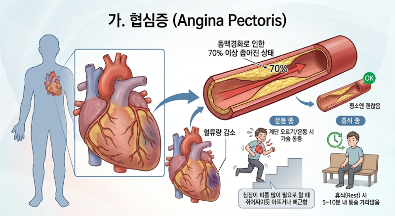 [건강정보]관상동맥질환(허혈성 심장질환) 원인부터 증상, 치료법까지! 심근경색·협심증 예....