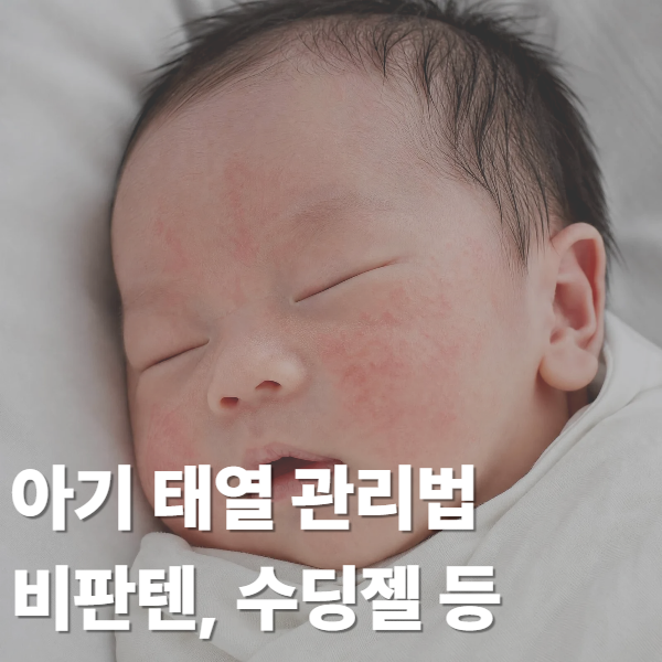 아기 태열 관리 언제까지? 비판텐, 수딩젤 관리방법