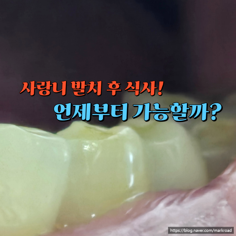 사랑니 발치 후 식사 언제부터? 통증 줄이는 음식 선택법