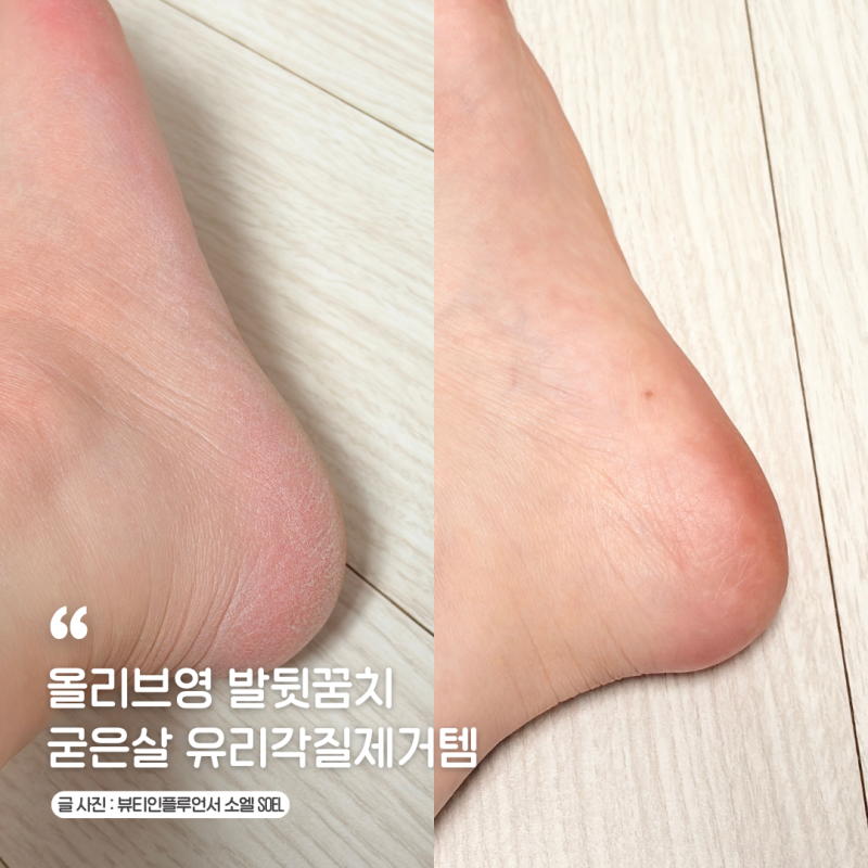크림과 제거제가 하나로! 발뒤꿈치각질제거패드 정보 올리브영 발뒷꿈치 굳은살 유리각질제....