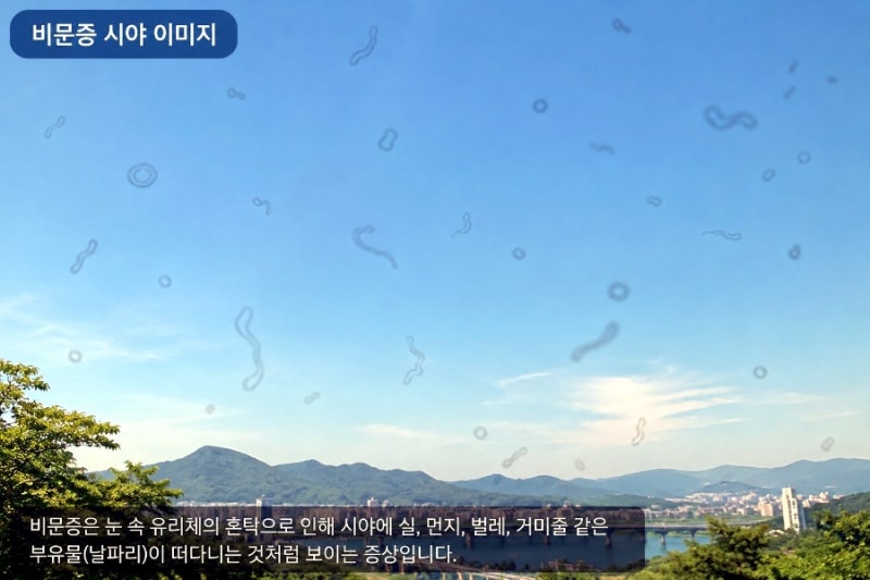 마산 비문증 초파리증 안과 후기 오른쪽 눈에 점이 떠다니는 게 보여 밝은안과·아인스안과 ....