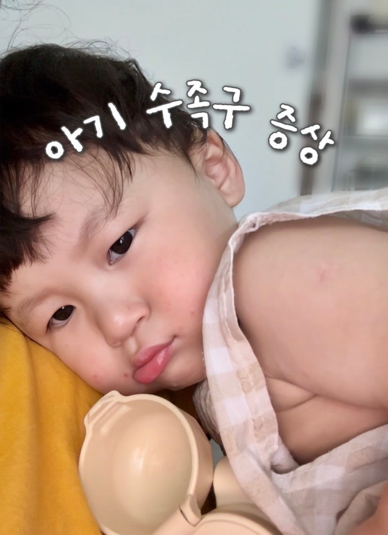 수족구 초기 증상부터 격리기간까지 ｜ 아기 수족구 전염성, 등원 시기 등 정보 총정리