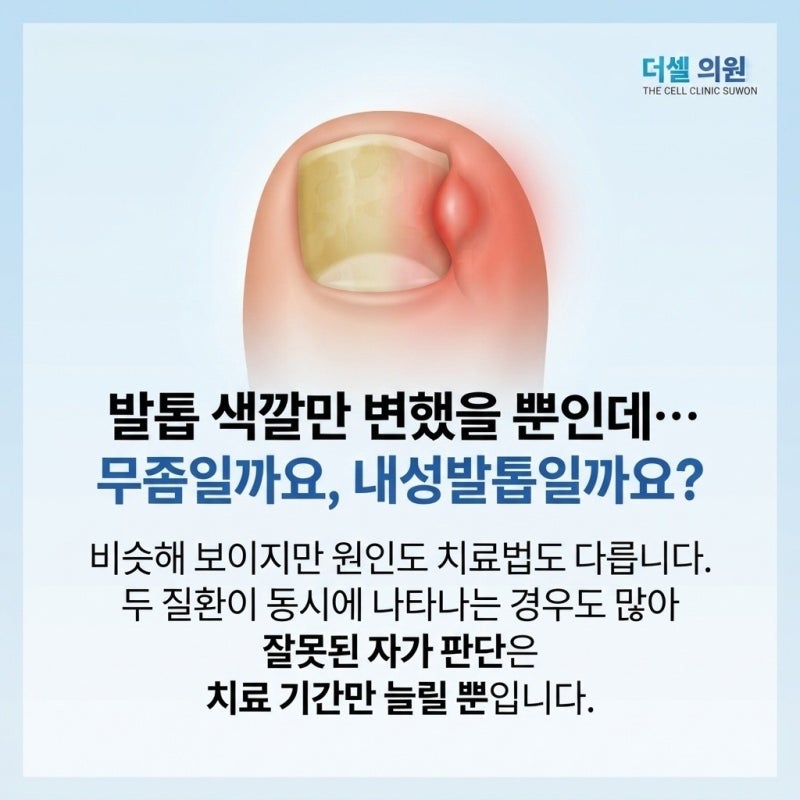 수지 발톱무좀병원 어디서 치료받을까, 진단부터 교정까지 직접 확인해야 하는 이유
