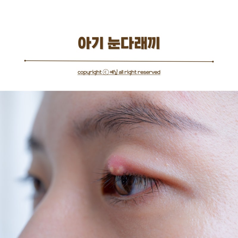 아기눈밑부음 눈붓기 아기눈다래끼 어린이다래끼 관리법
