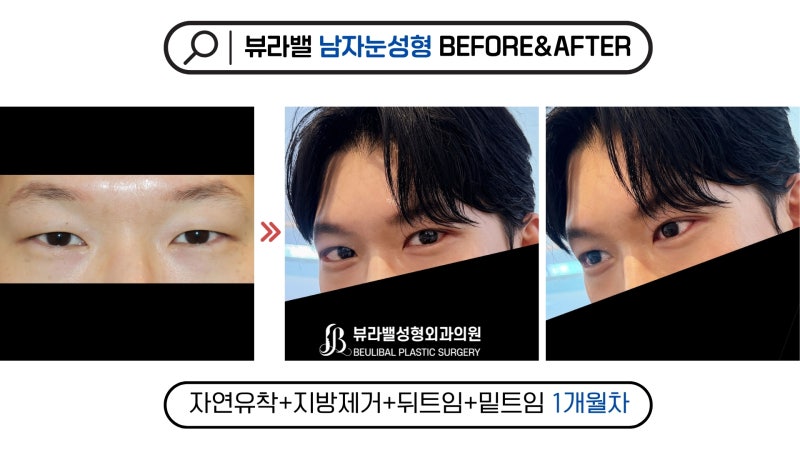 남자눈성형, 눈매교정은 꼭 해야 할까?｜무쌍·속상 디자인 기준과 리얼 전후사진｜강남 뷰....