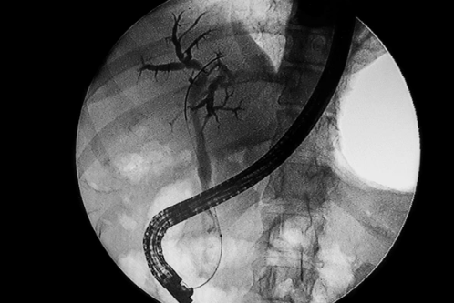 ERCP(내시경적 역행성 담췌관조영술)란? 검사 방법부터 부작용까지