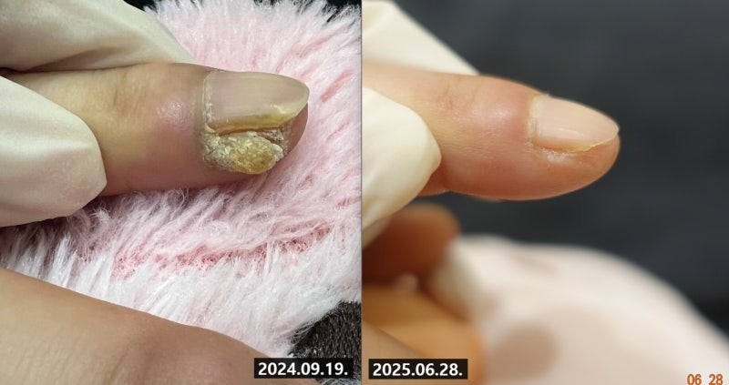 상동 손가락 피부 사마귀 치료 후기 "전염될까 걱정인데 냉동 제거나 주사, 연고로도 재발? " ....