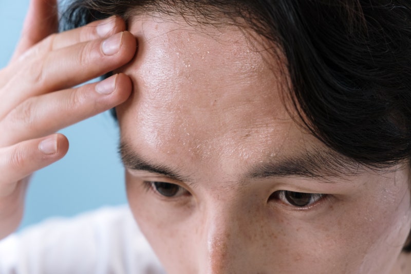 성인 땀띠 모낭염 차이와 엉덩이 땀띠 곰팡이 및 허벅지 안쪽 땀띠 구분법