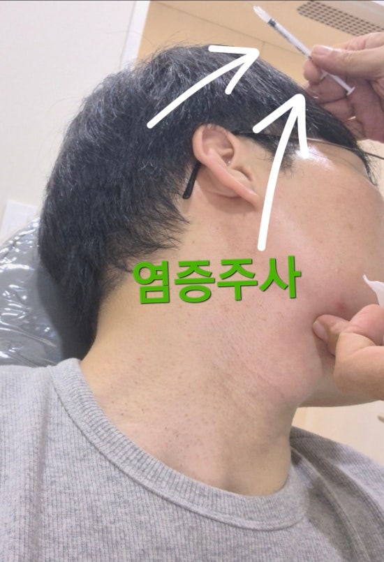 짜지지 않는 속여드름 결절성여드름 염증주사 맞고 온 피부과 후기