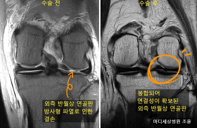[전방십자인대 +외측연골판 방사형 파열] 28세 남성 풋살 수상, LET(ALLR)를 하면 외측 연골판이 ....