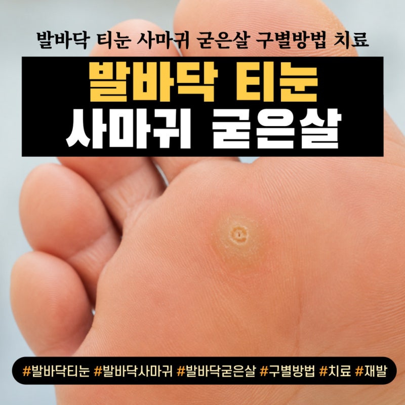 발바닥 티눈 사마귀 굳은살 구별방법과 제거 및 치료