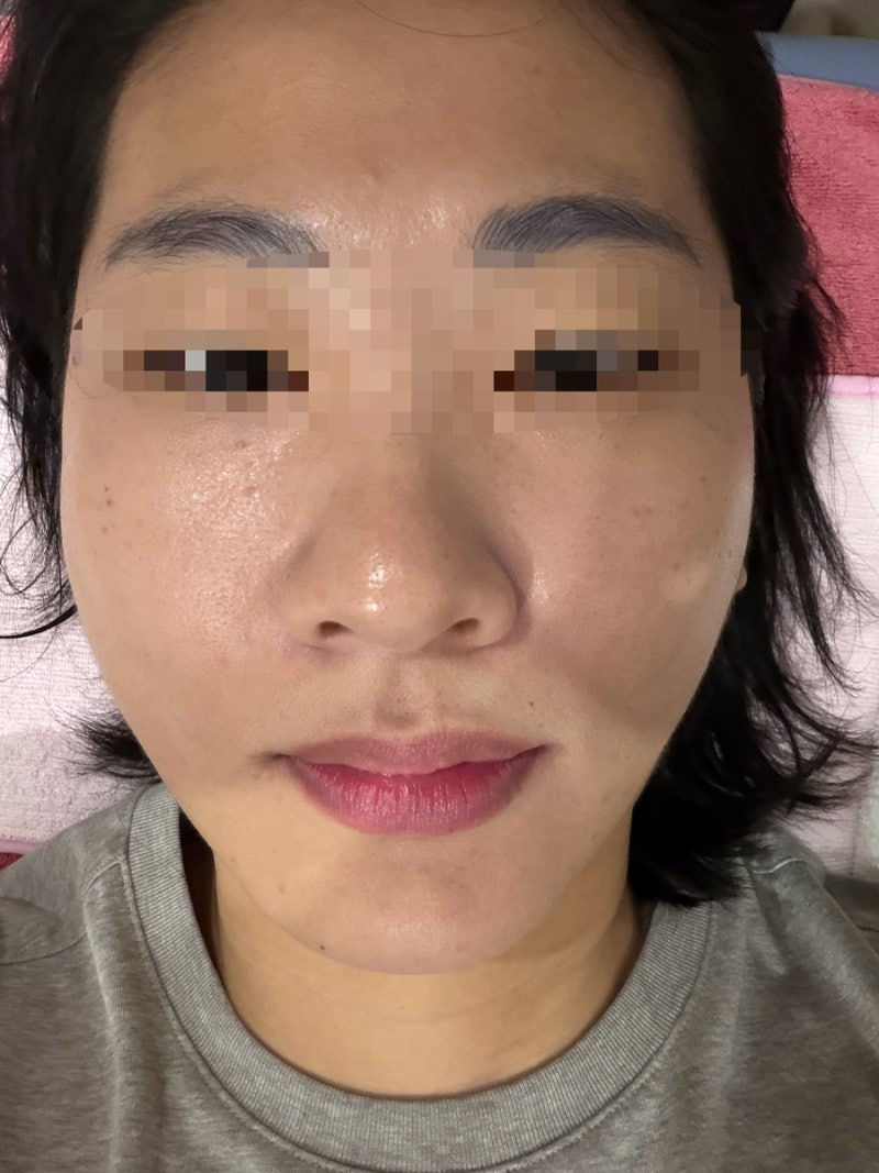 화접몽한의원에서 평편사마귀제거 후기