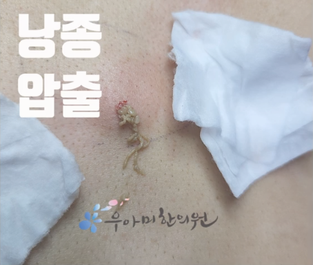 엉덩이 피지낭종 병원, 종기•뾰루지•모소낭으로 진단이 달랐던 이유와 제거 비용