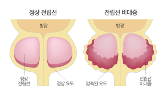 [URO-비뇨기] 전립선 수술에 대해서