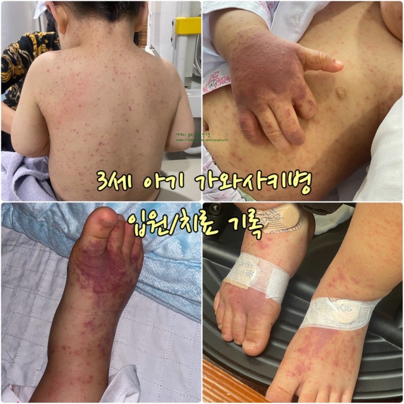 가와사키병 신촌 세브란스 어린이병원 입원 치료 후기 (2인실 비용, 주차 정보)