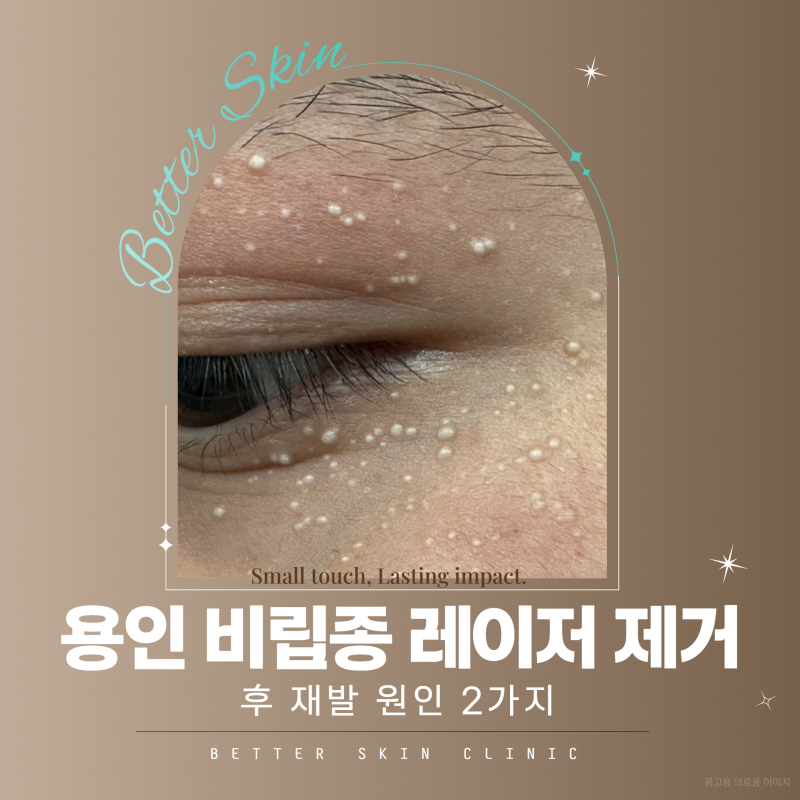 용인 비립종 레이저 제거 후 재발 원인 2가지