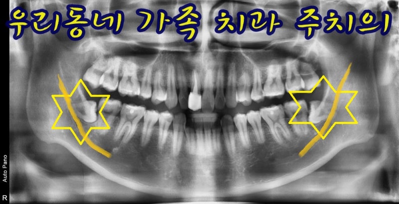 파노라마에서 신경관과 겹쳐 보이는 사랑니, 꼭 대학병원에 가야 할까요? 부평 구강외과 전....