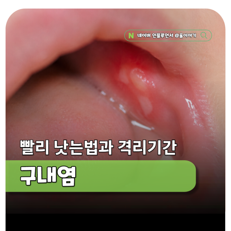 아기 구내염 어린이집 언제부터 갈까? 전염 격리기간 총정리
