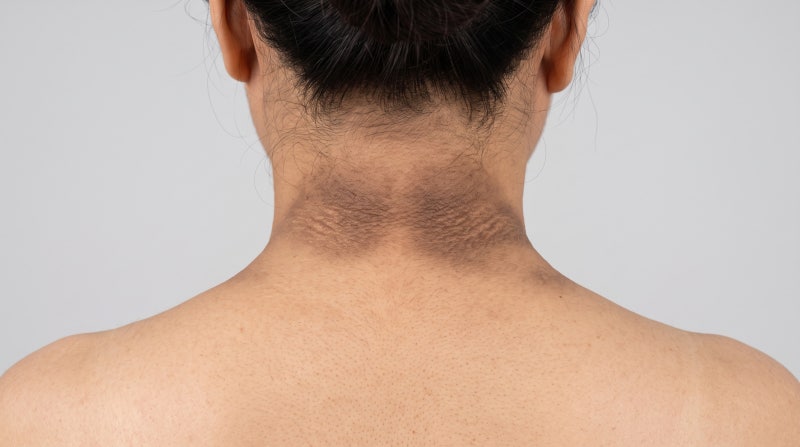 목 뒤가 아무리 밀어도 거뭇하다면? 때가 아니라 '당뇨 전 단계' 신호일 수 있습니다 (전문의 ....