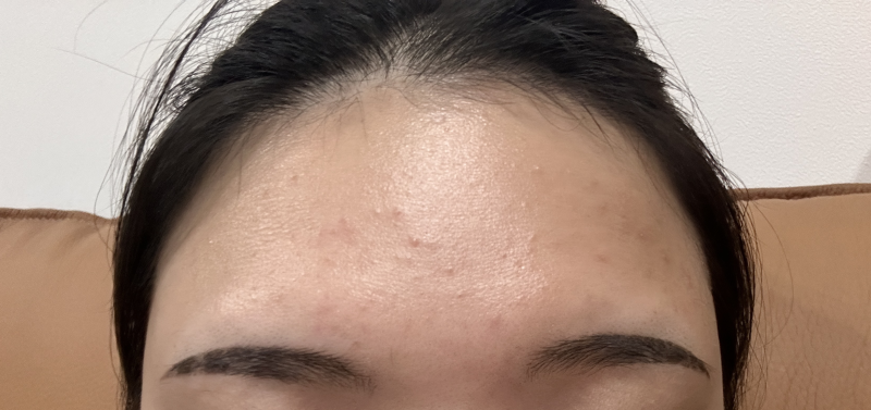 쿠팡에는 정녕 모낭염인을 위한 선크림이 없을까? 무기자차 선크림 모낭염 유발 성분 확인 ....