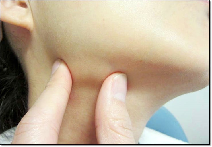 목에 멍울이 만져지는 이유, 목 혈관 주변 멍울 증상과 원인 치료