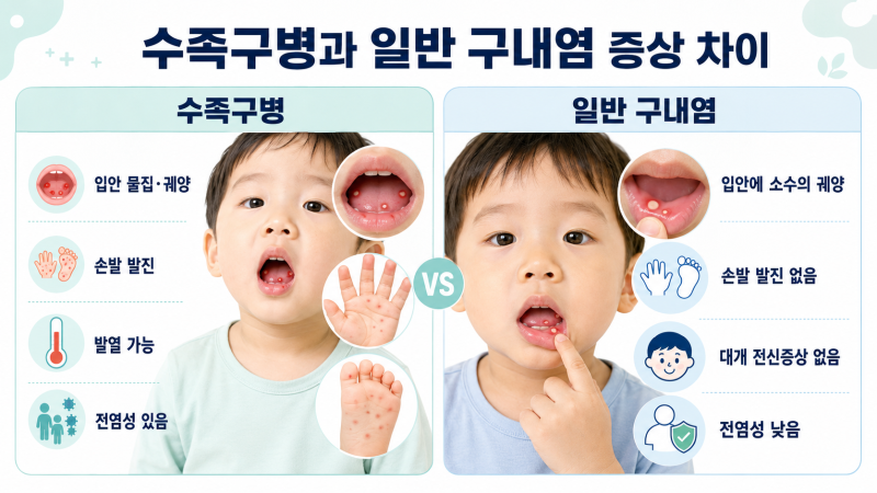 수족구와 구내염 차이, 아이 입안 물집과 손발 발지으로 구별할 수 있을까?