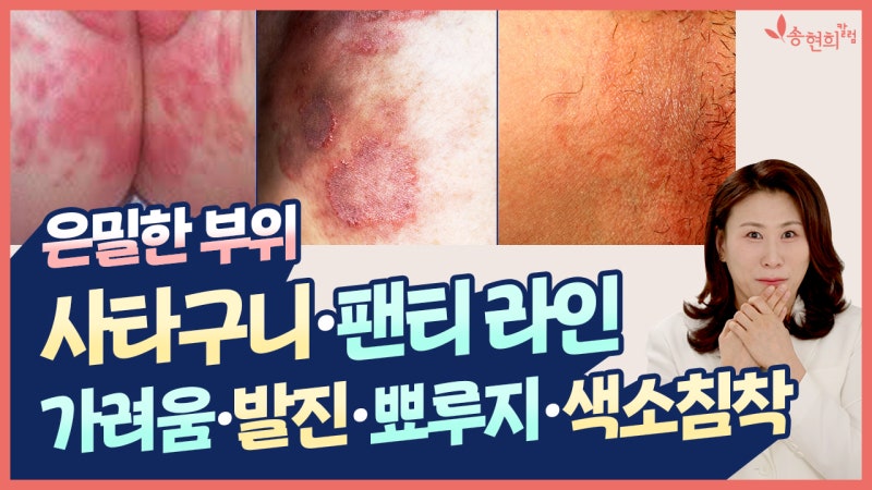 허리·사타구니 피부 가려움 해결법 ft. 완선, 간찰진, 접촉피부염 감별, 주의사항