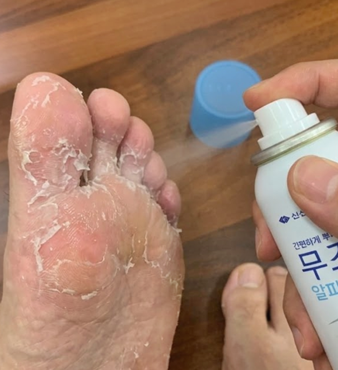 무조무 스프레이 알파 에어로솔 지독한 무좀 관리 후기