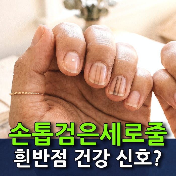 손톱으로 보는 건강: 손톱 검은세로줄과 흰반점이 주는 건강 신호