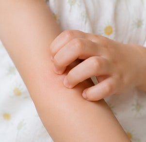 아기 모기 물렸을 때 심하게 붓는 이유와 연고 사용법