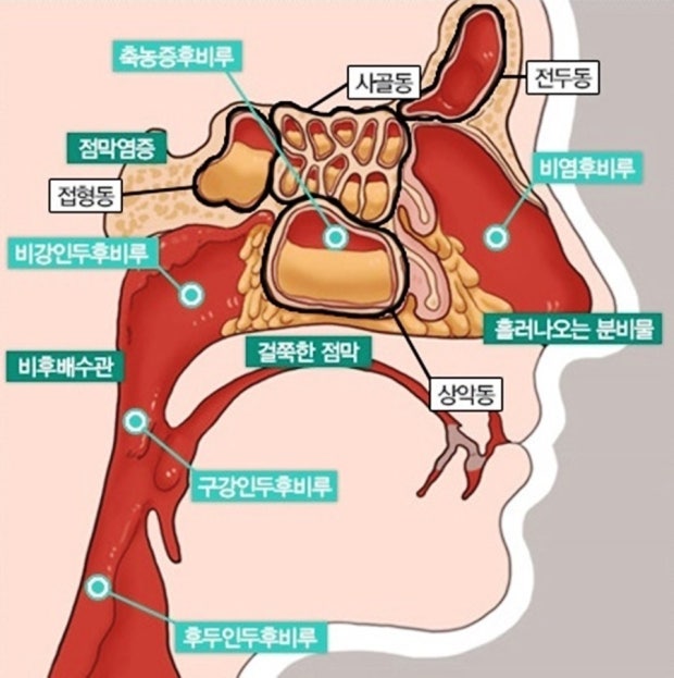목이 간질간질하고 기침이 나는 이유, 후비루 증상일까?