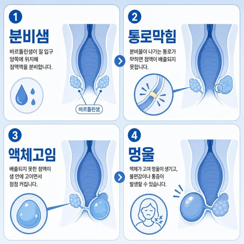 질 입구 여드름 뾰루지 바톨린낭종 생기는 원인과 치료 방법은?