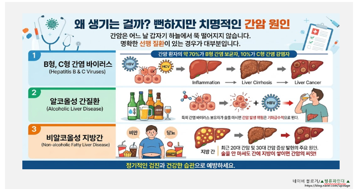 5년 생존율 38%의 공포? 간암 초기증상 및 절대 놓치면 안 될 전조증상 3가지