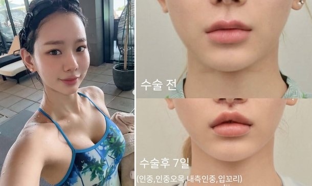 맹승지, 5년 고민 끝에 수술 결심…12년 만에 얼굴 이렇게 달라져?
