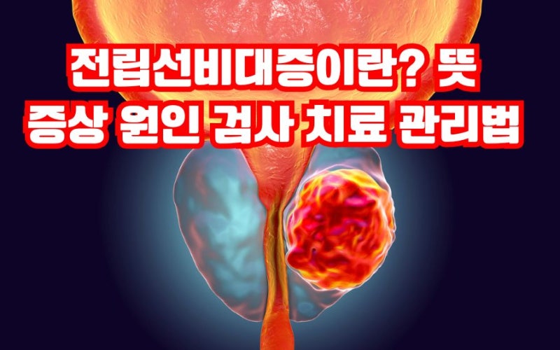 전립선비대증이란? 소변줄기 증상 원인 검사 치료 관리법 좋은음식 영양제