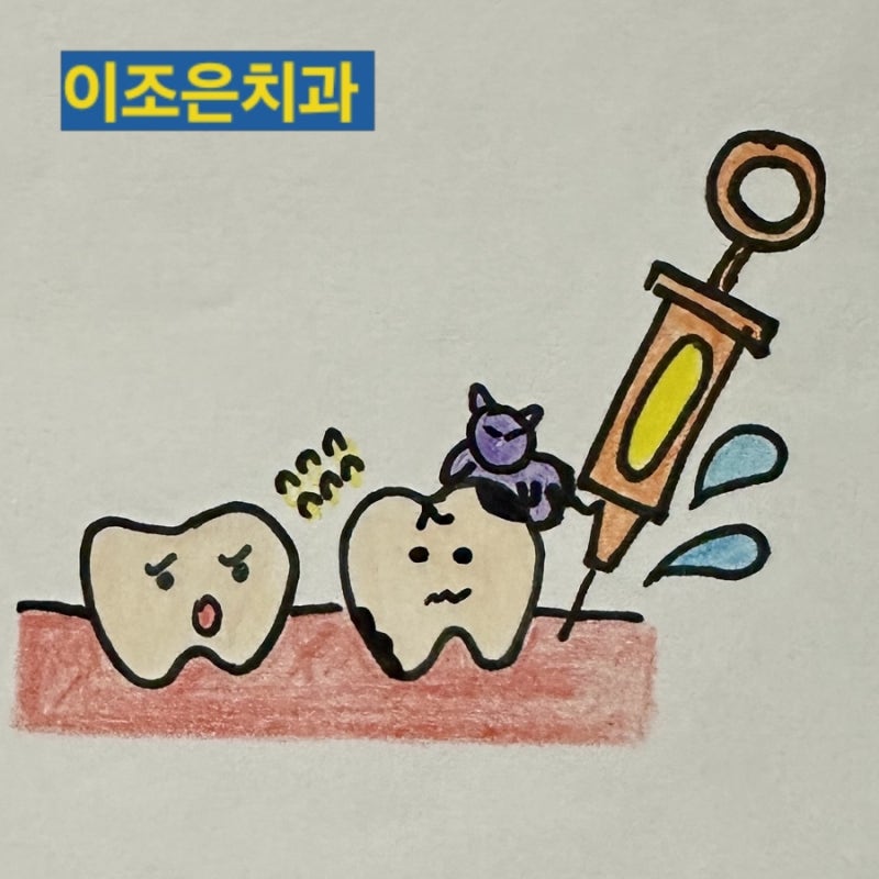 인천 부평 삼산동치과 사랑니를 뺄 때 지혈제를 써야 될까요?