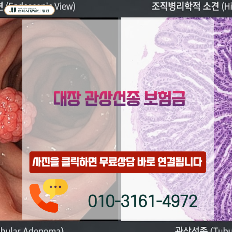 대장 관상선종 보험금, D12 코드인데 제자리암 진단비 받을 수 있을까?