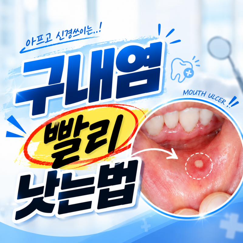 구내염빨리낫는법,입술 안쪽 구내염에 알보칠 사용해본 후기