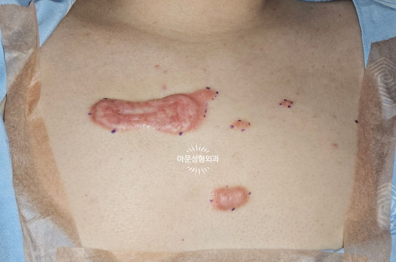 가슴 켈로이드, 방사선 치료 위험하진 않나요? (서울 강동구 아문성형외과)