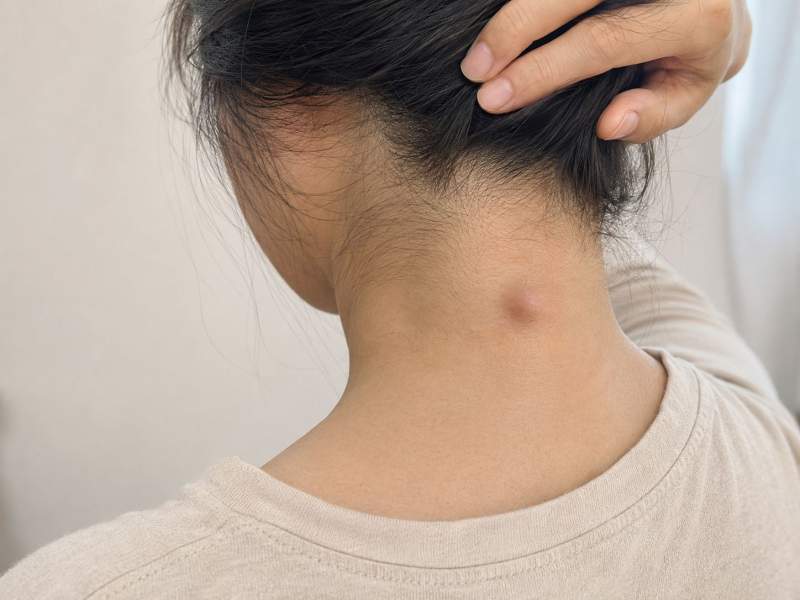 표피낭종 피부과 외과 어디로? 피지낭종 제거 수술비