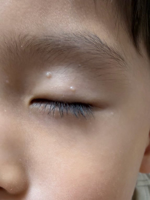 5살 아들 물사마귀 치료 후기