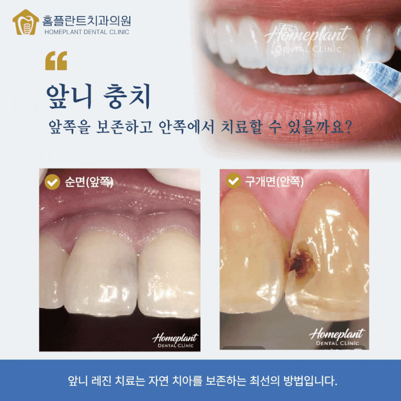 교대역 치과｜앞니 충치, 앞쪽을 깎지 않고 안쪽으로 치료한 이유 : 건강한 치아조직 보존