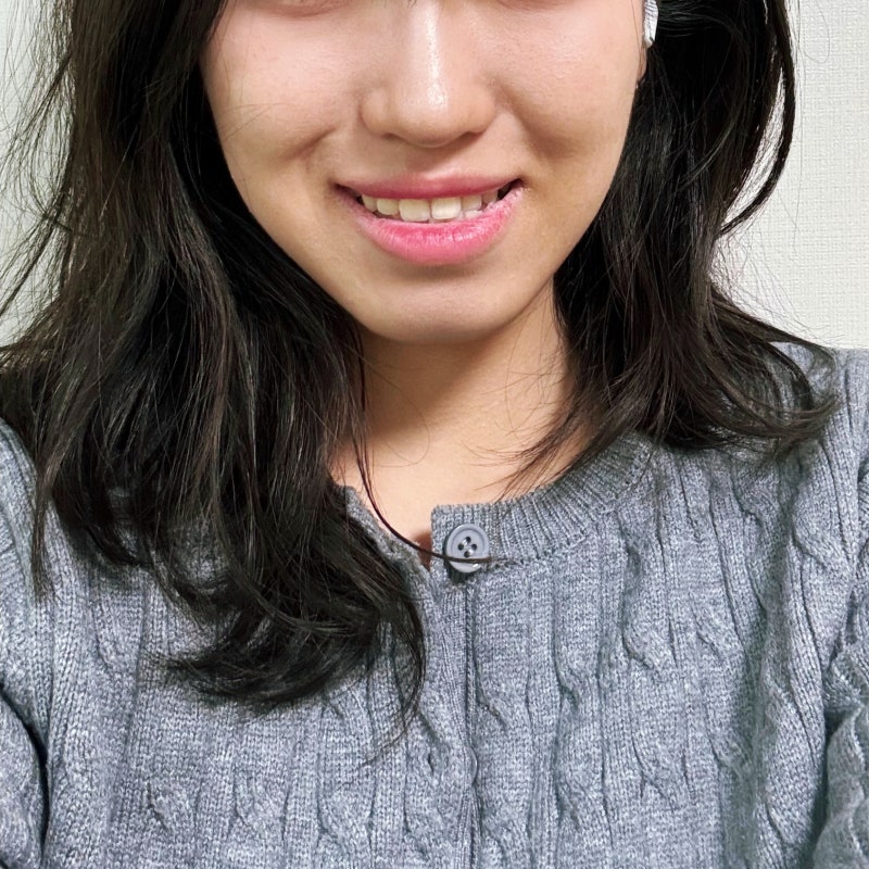 잇몸성형, 거미스마일 보톡스 4주 후기
