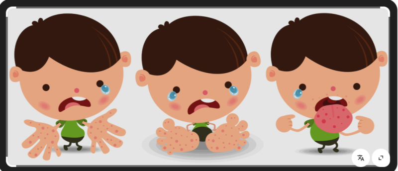 아이 수족구, 부모에게도 옮을까? 증상과 어른 전염성 알아보기