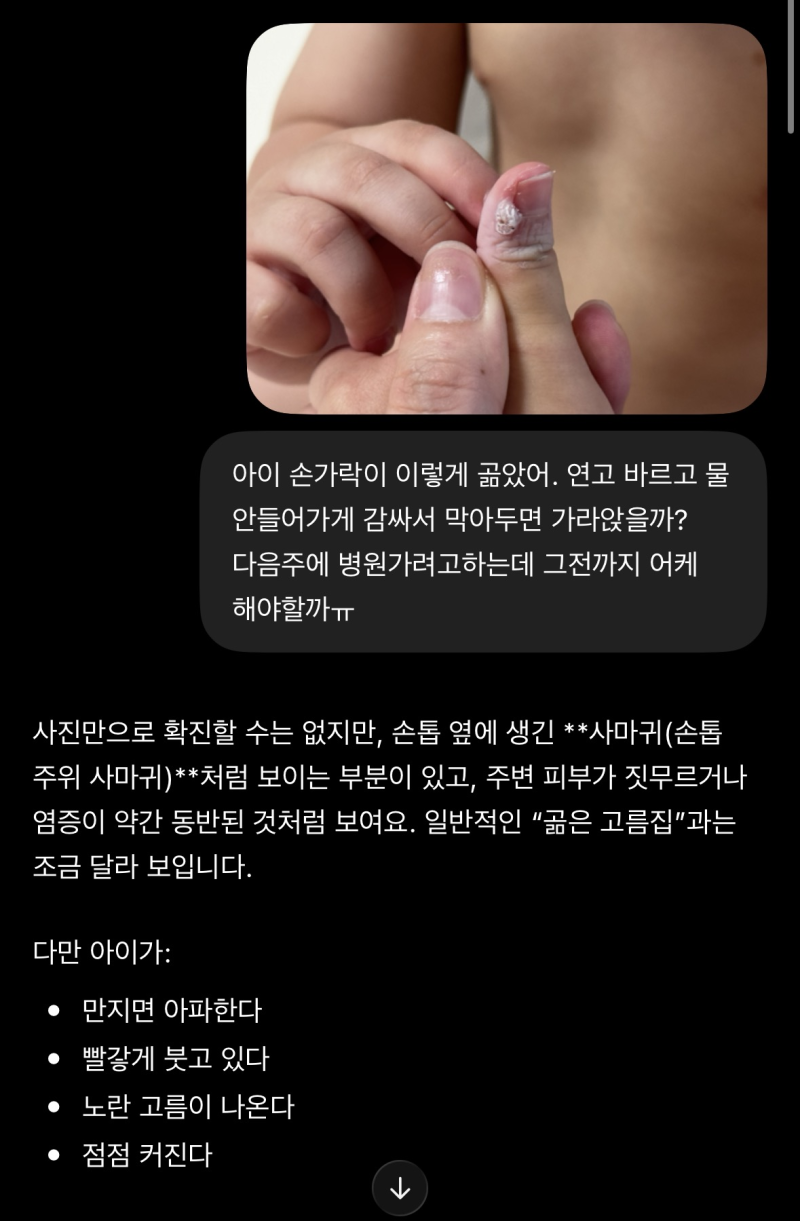 30개월 아기 손고름, 사마귀 치료방법 (냉동치료 불가) 베루말 처방 한달치료 후기